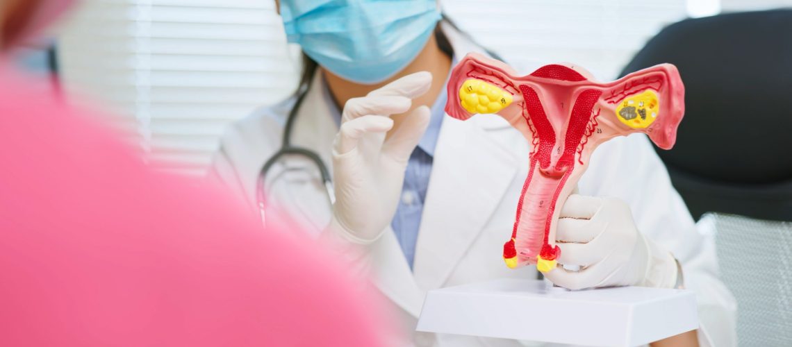 Síndrome do Ovário Policístico