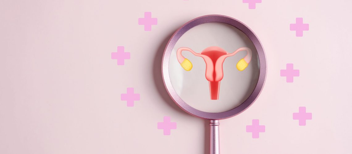 Síndrome dos Ovários Policísticos